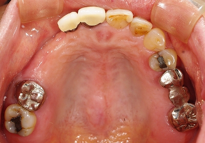 上顎の多数歯欠損をインプラントで修復 | あき歯科医院の医院ブログ